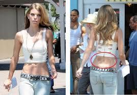 吸い玉 カッピング 療法 えがお鍼灸整骨院